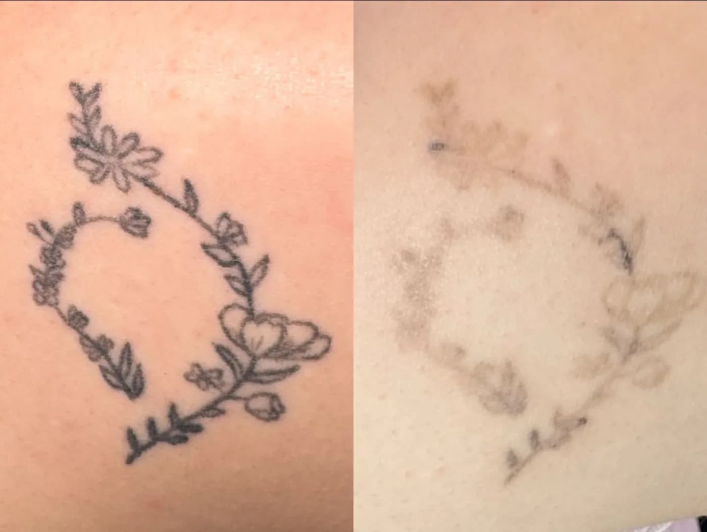 Før og etter kun to laserbehandlinger for tatoveringsfjerning hos SOMI Klinikken i Sandnes